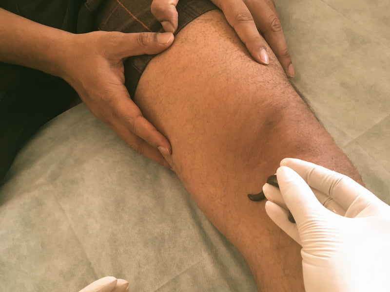 The Efficacy of Leech Therapy in curing soft tissue injuries