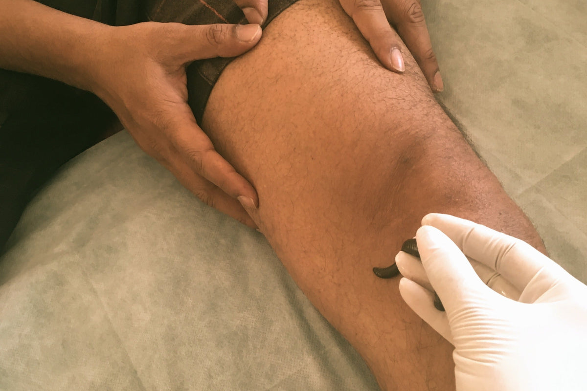 The Efficacy of Leech Therapy in curing soft tissue injuries